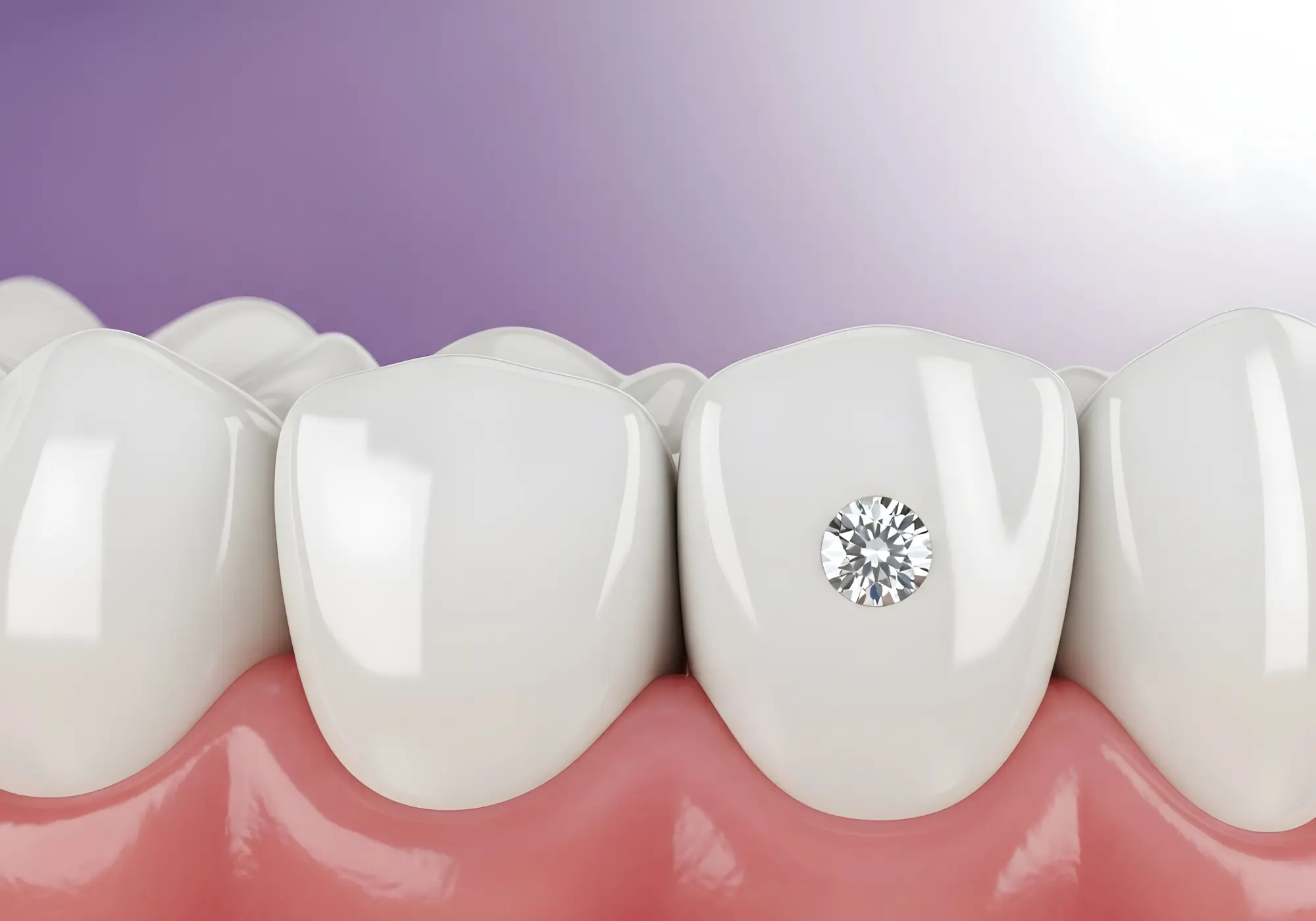 Safe Tooth Gem Removal in Eugene, OR | Hudson Dental