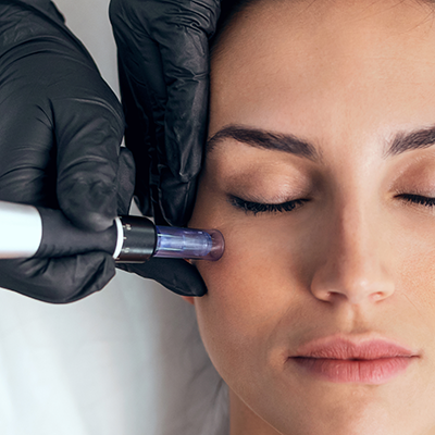 Woman receiving a microneedling for skin.