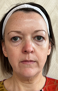 photo of individual before tox