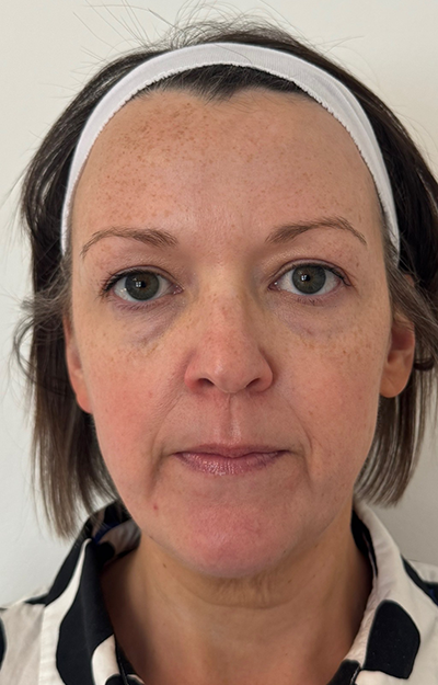 photo of individual after tox