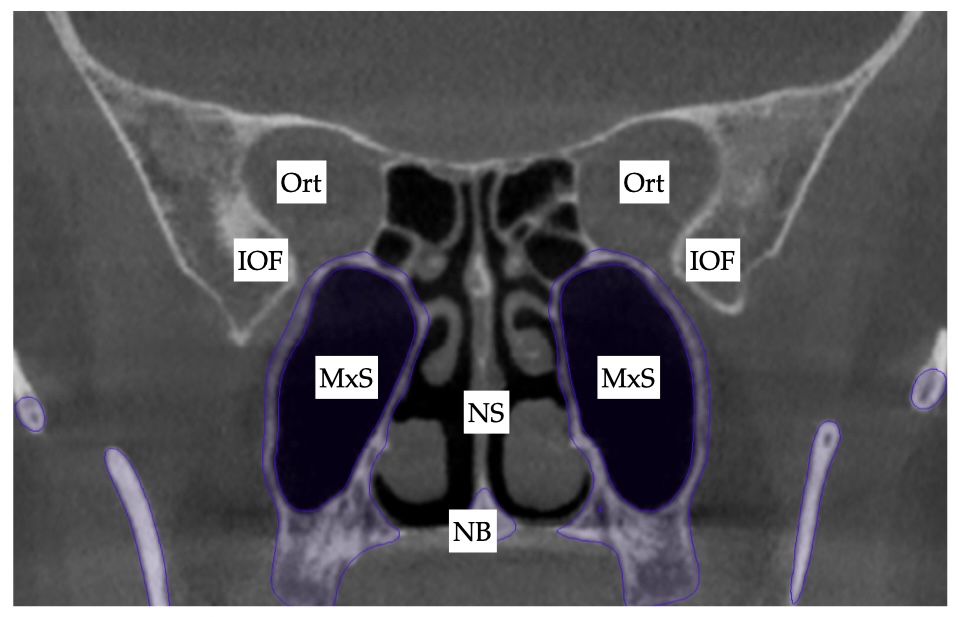 Does Nasal Septum Get Better with MARPE treatment?
