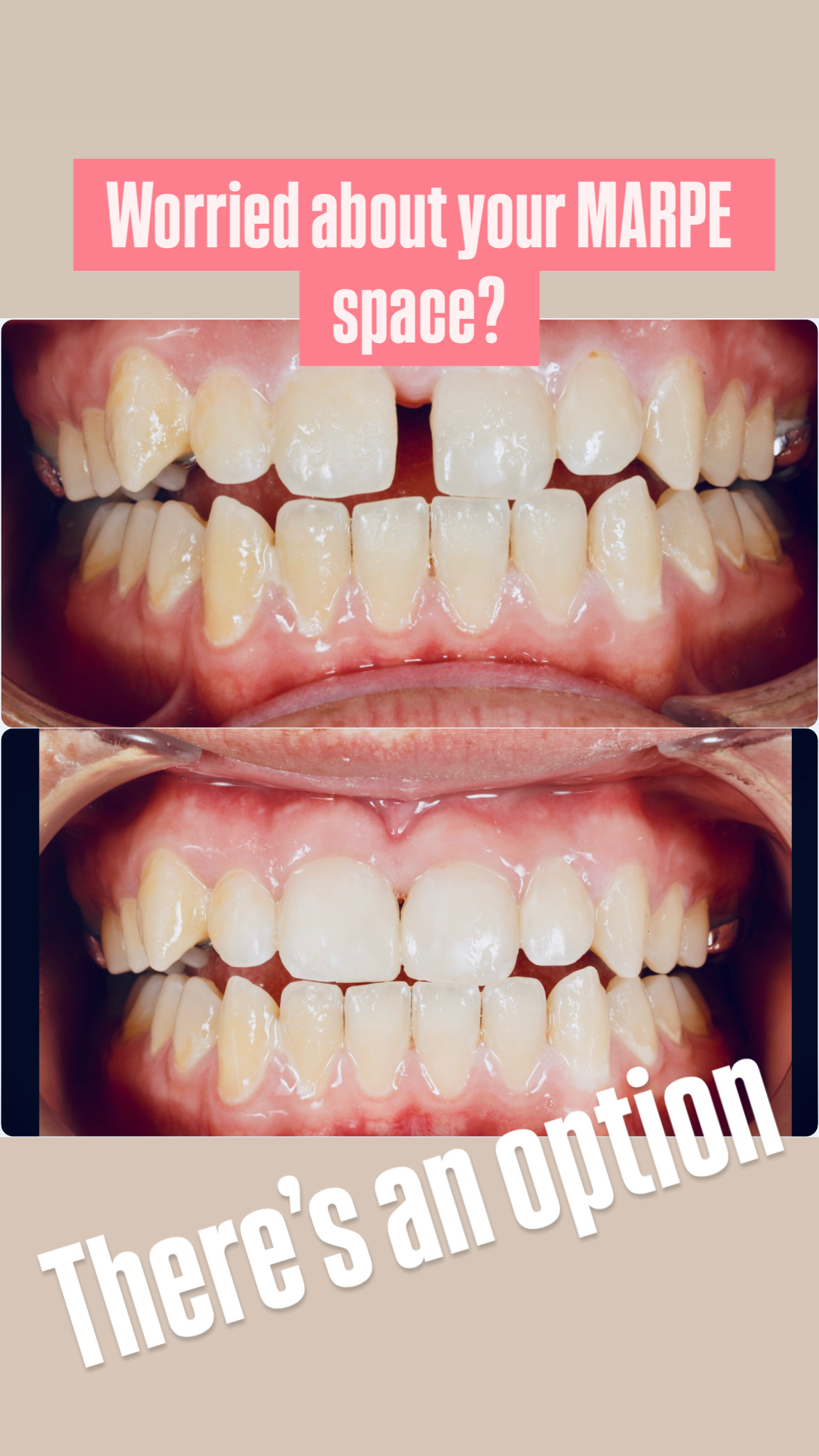 How To Hide a Developing Gap with MARPE treatment?