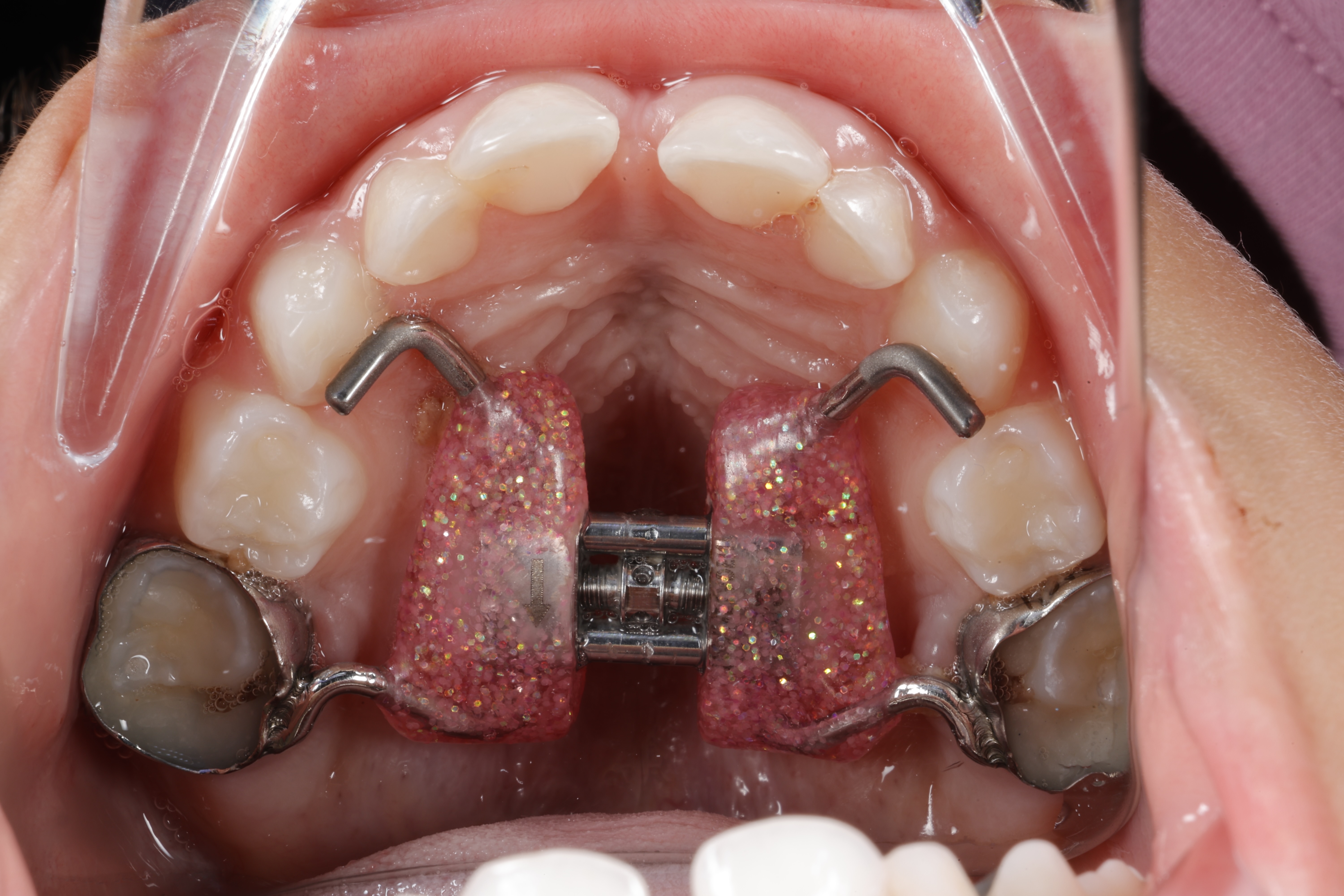 How to Eat with a Palate Expander