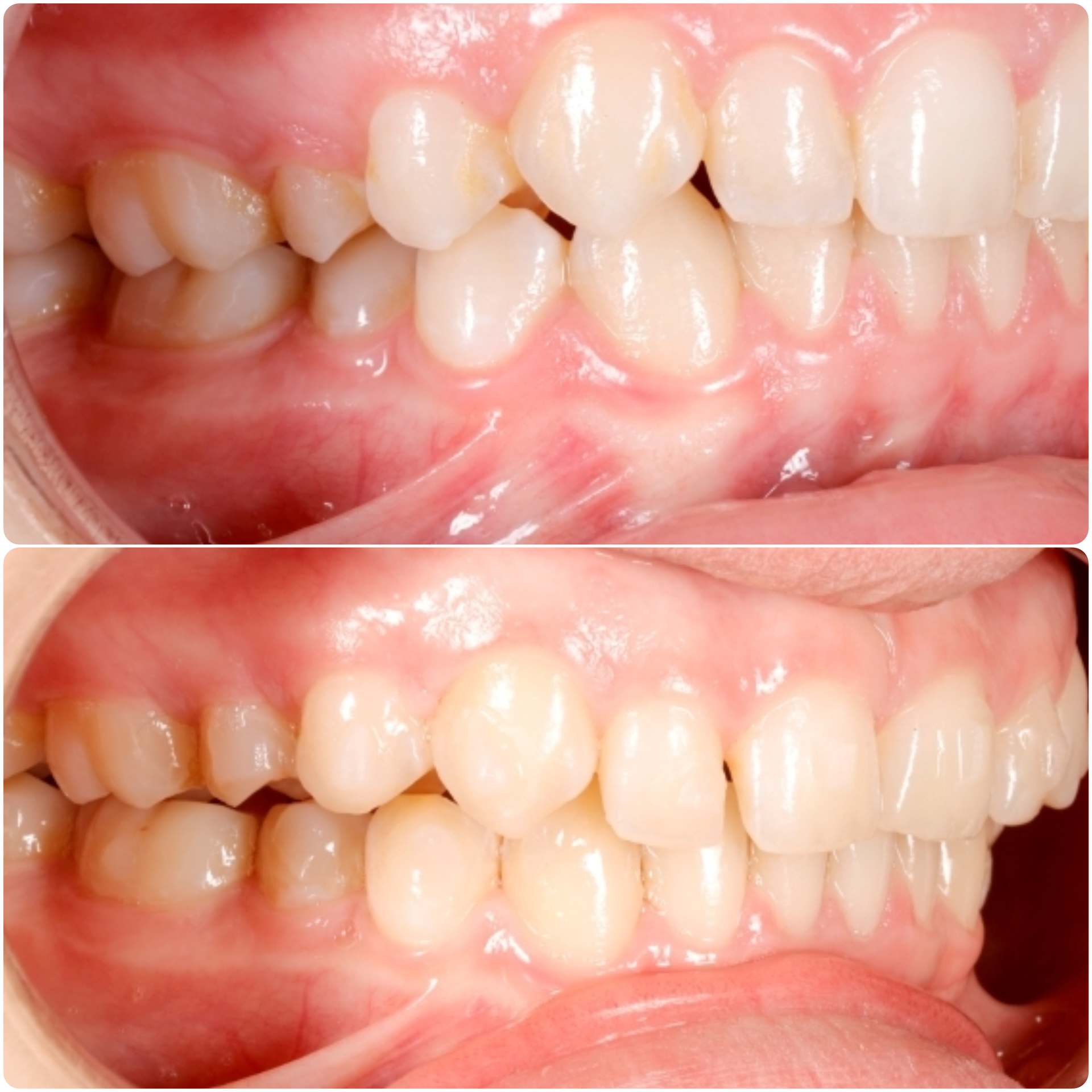 Maxillary and Mandibular Advancement: Myth or Reality?