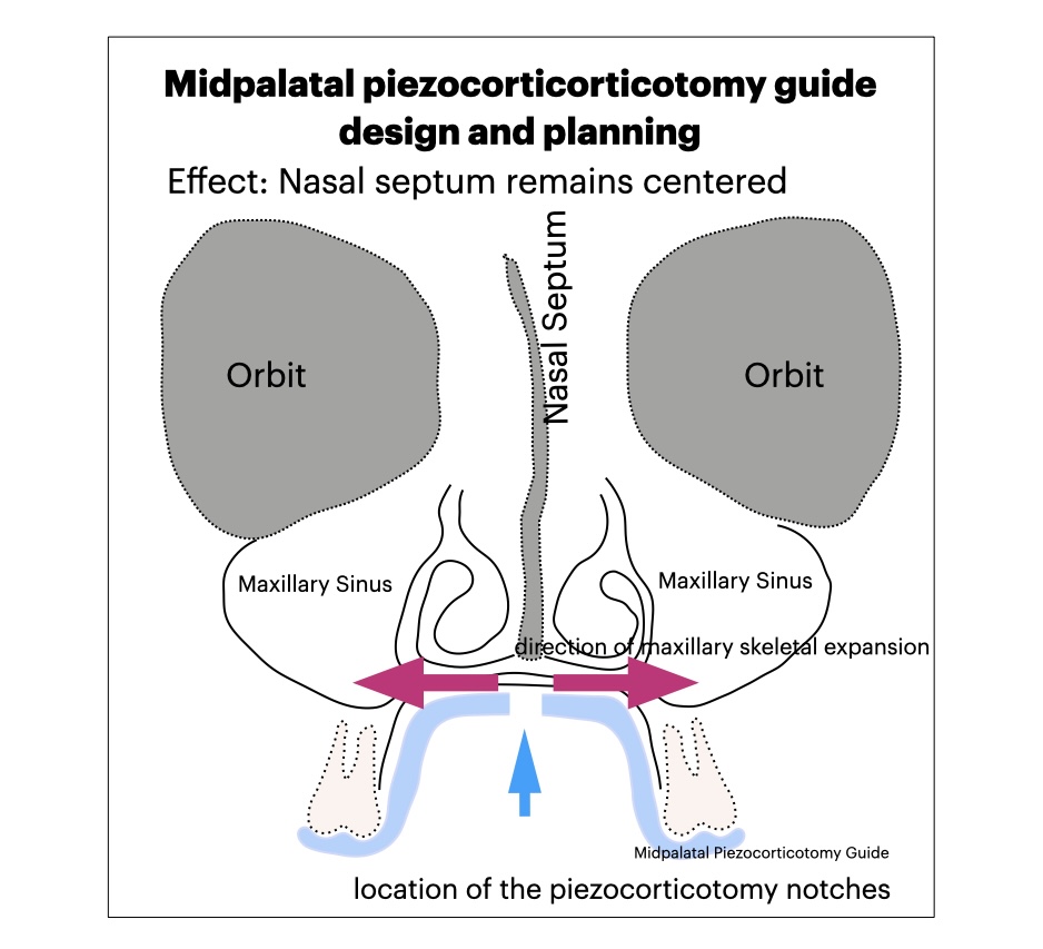 How much can you expand without a cross bite? Molar tipping of the lowers can accommodate how much expansion?