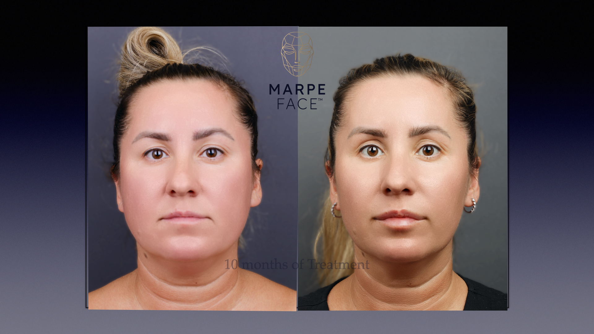 MARPEFACE protocol by Dr.Svitlana Koval