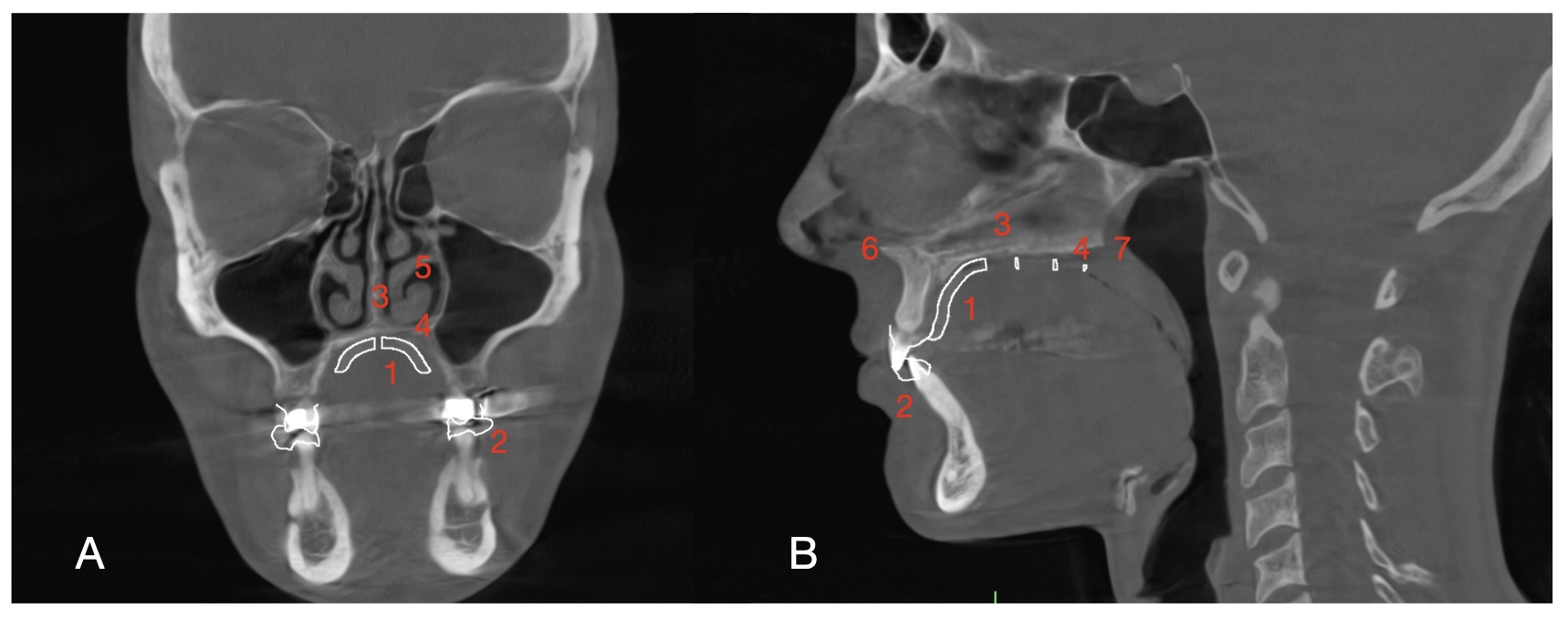 How Dr. Koval’s MARPE F.A.C.E. Uses Pre-Treatment Scans to Customize Adult Palate Expansion