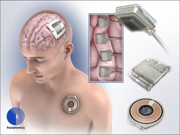 Paradromics Connexus® Direct Data Interface: (from top right) Cortical modules record signals from 1600+ individual neurons; Cranial hub powers cortical modules and completes signal processing; Wireless transmitter (subcutaneous) provides power and secure, high-bandwidth data relay