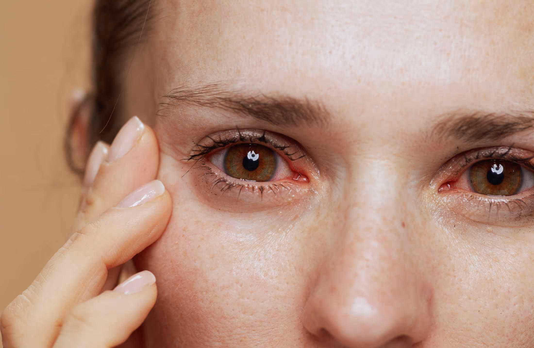 Close-up of a person's face with red, irritated eyes and hand touching the cheek.
