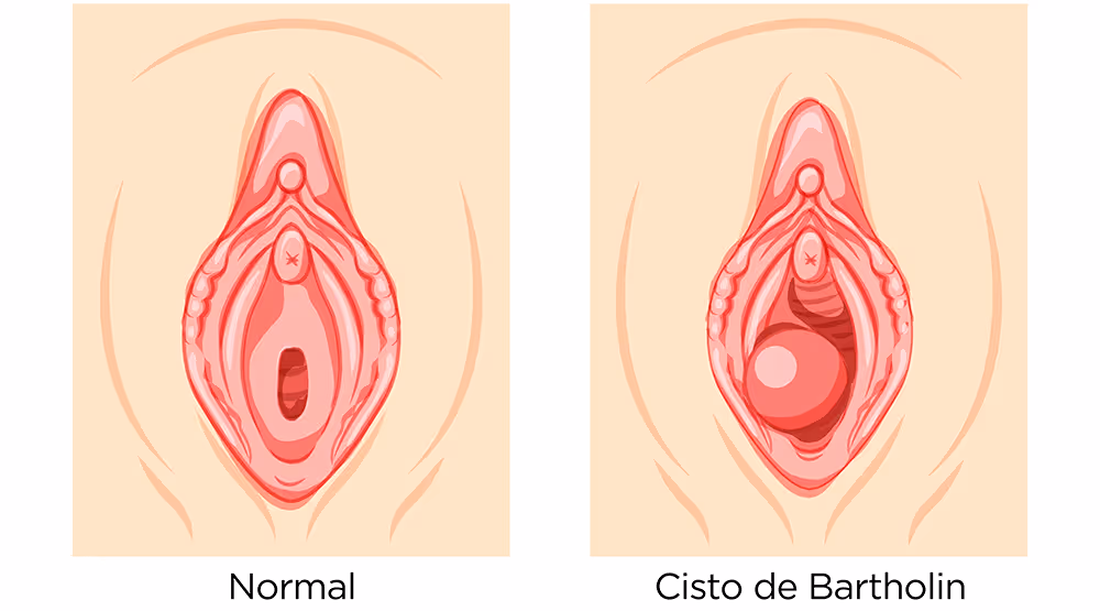 Side-by-side diagrams of female vulva: normal anatomy vs. Bartholin cyst with round swelling inside.