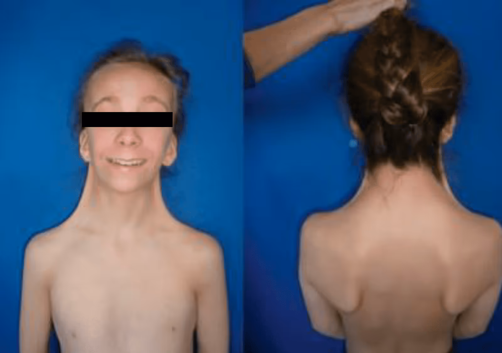 Front and back view of a shirtless child with black bar obscuring eyes and scapular winging visible on back.