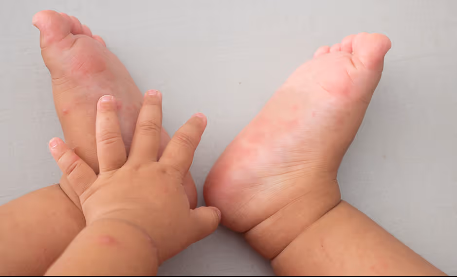 Child's hand touching the soles of their feet, showing mild red rashes on skin.