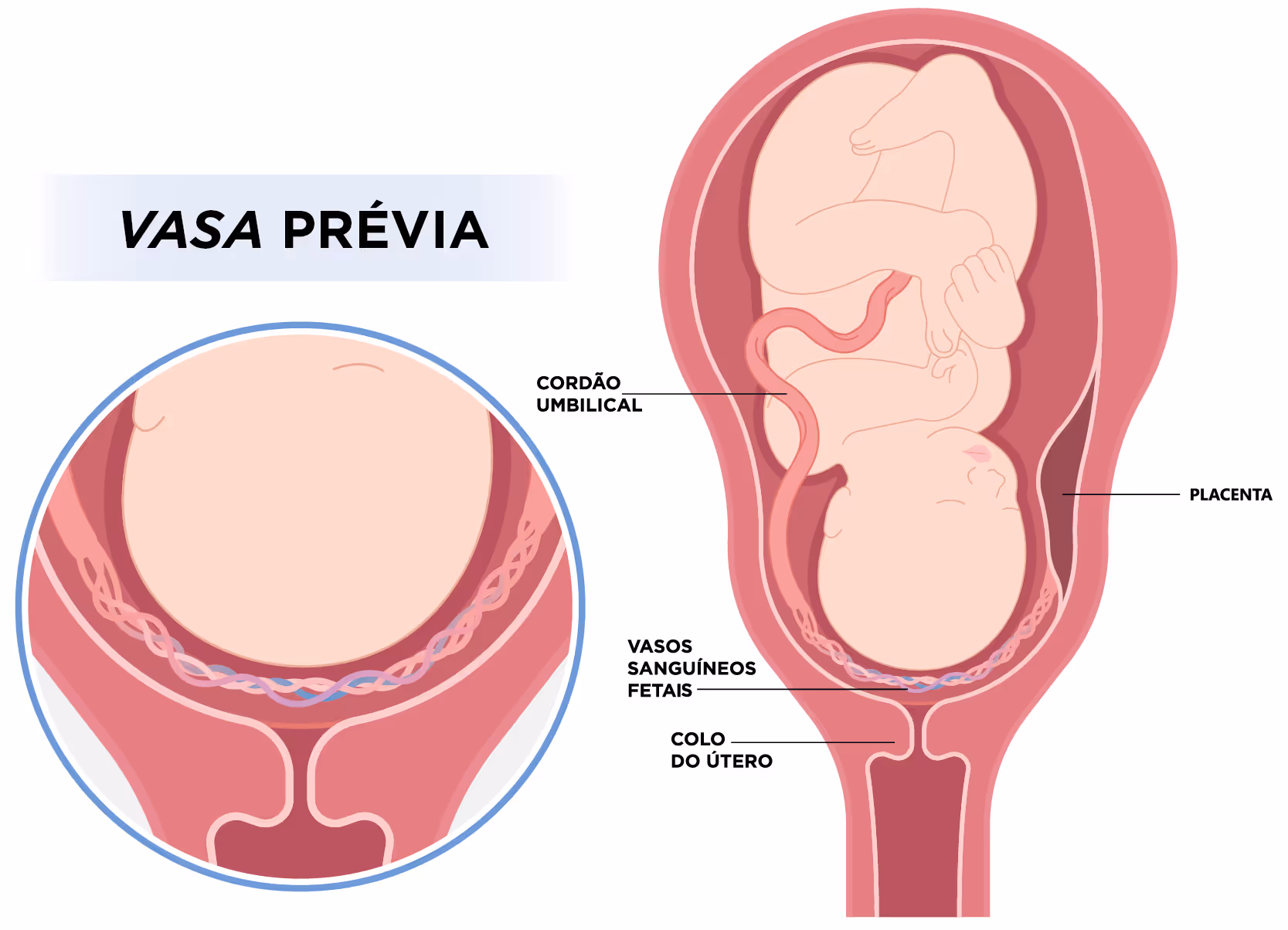 Illustration of vasa previa showing fetal blood vessels crossing the cervix beneath the baby and placenta.