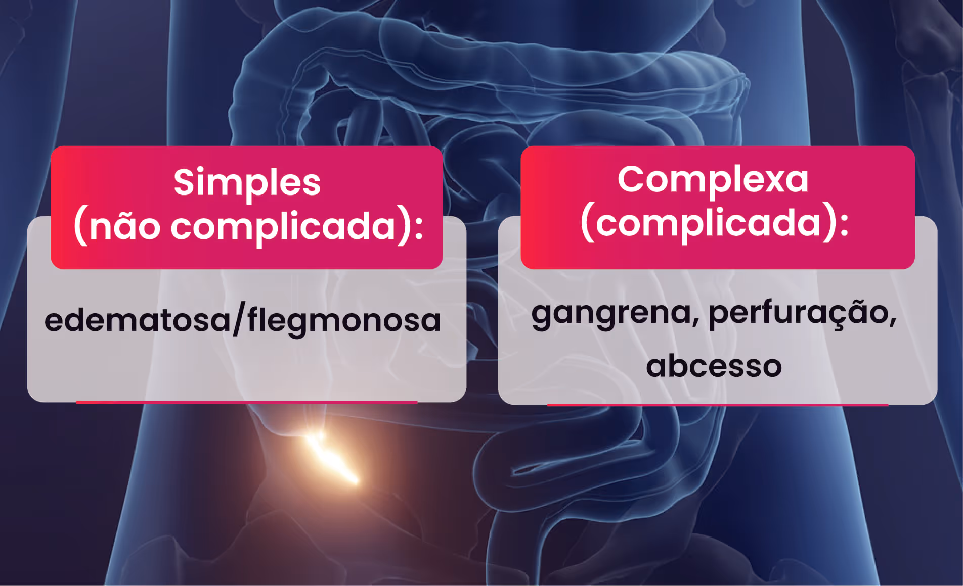 Diagram shows simple (edematous/phlegmonous) and complex (gangrene, perforation, abscess) appendicitis types.