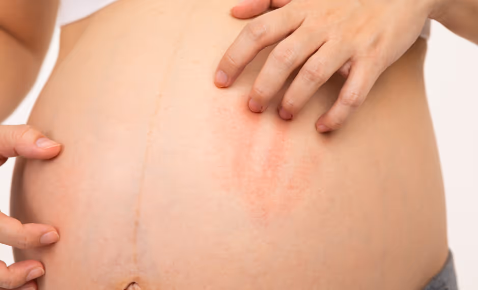 Close-up of a person scratching red, irritated rash on their bare abdomen.