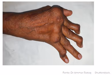 Brown-skinned hand with swollen joints and bent fingers resting on a white surface.