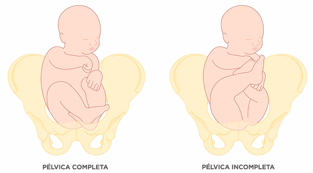 Two fetal position diagrams inside pelvis: left shows complete pelvic posture, right shows incomplete pelvic posture.
