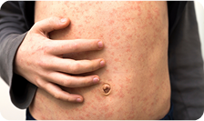 Stomach measles