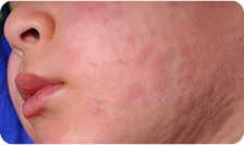 Cheeks measles