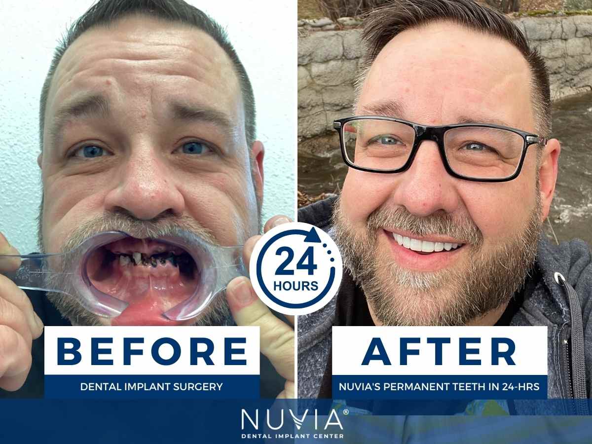 Before and after of patient to accompany dental implant reviews about the experience