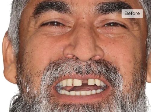 Man smiling before dental implants