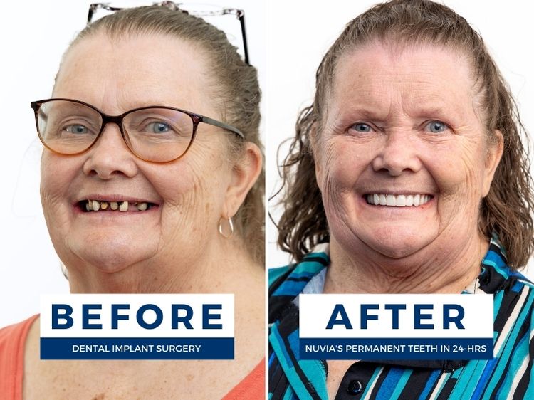Woman smiling before and after getting new teeth