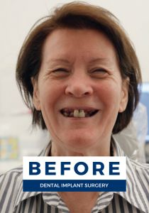 Sandy smiling before getting dental implants