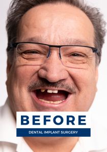 Man smiling before getting dental implants
