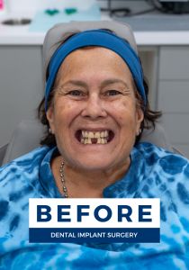 Woman smiling before getting dental implants