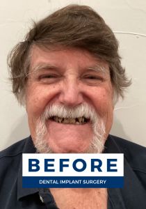 Man smiling before getting dental implants