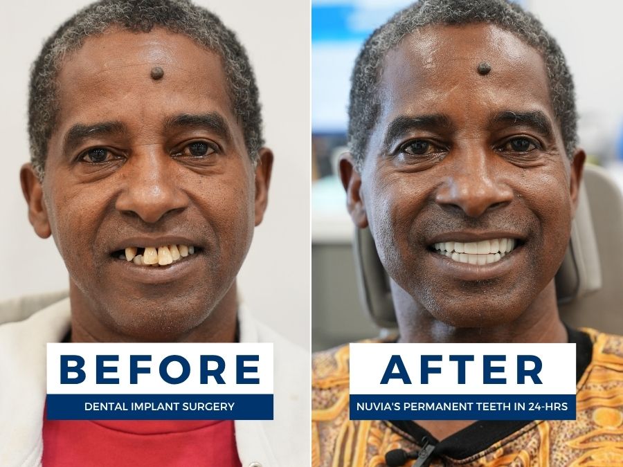 Man smiling before and after getting new teeth