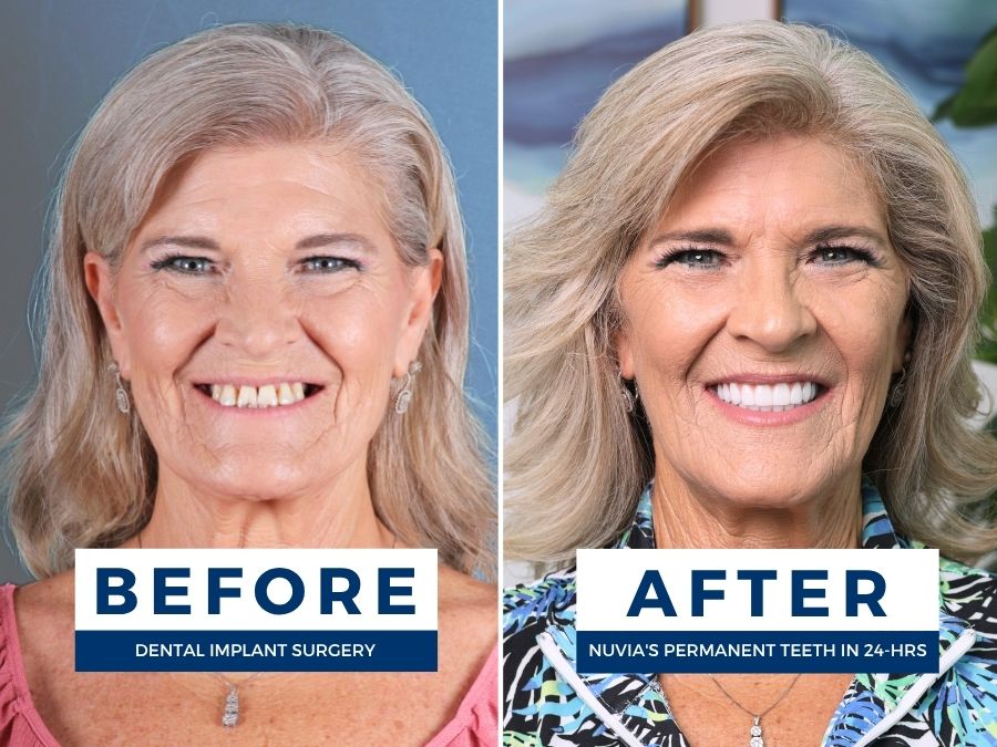 Woman smiling before and after getting new teeth