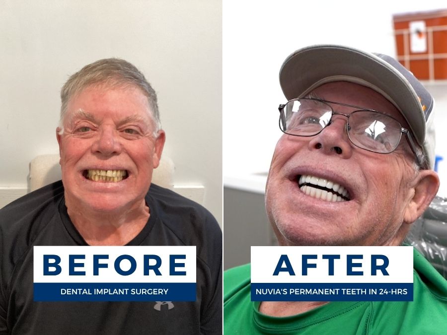 Man smiling before and after getting new teeth