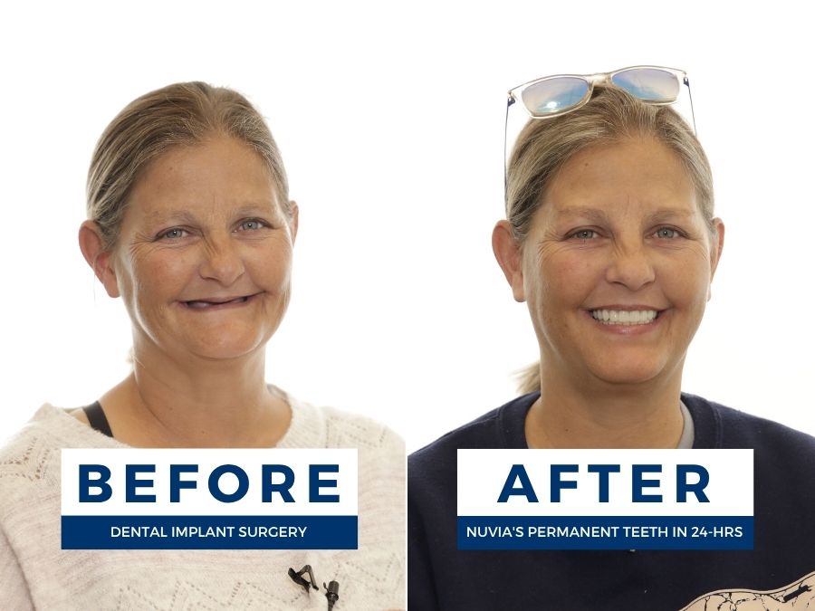 Woman smiling before and after getting new teeth