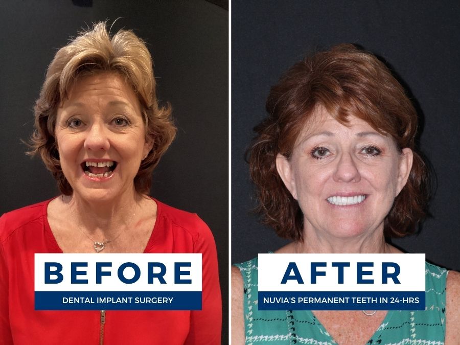 Woman smiling before and after getting new teeth