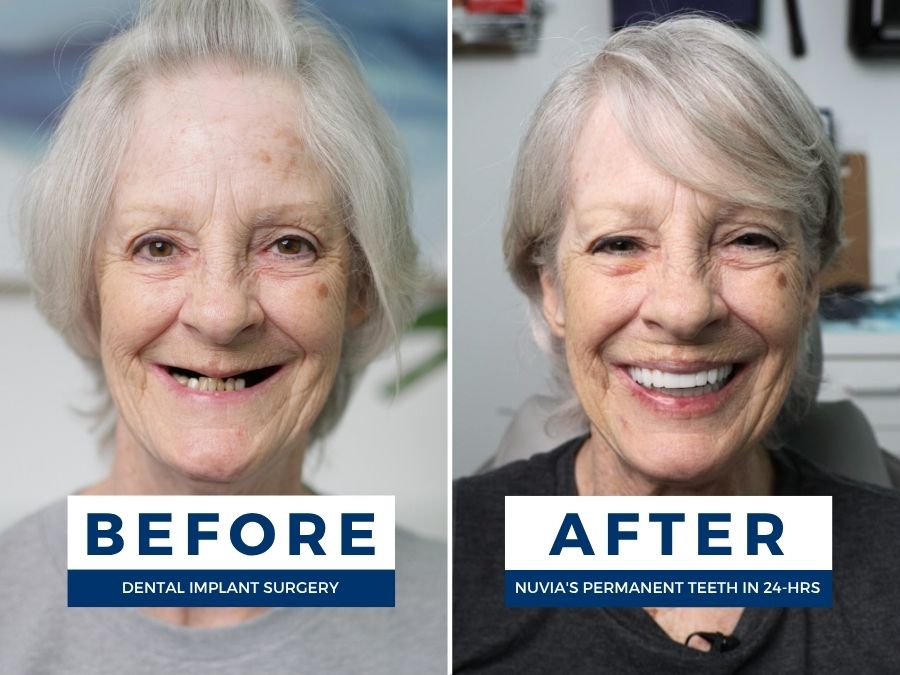 Woman smiling before and after getting new teeth