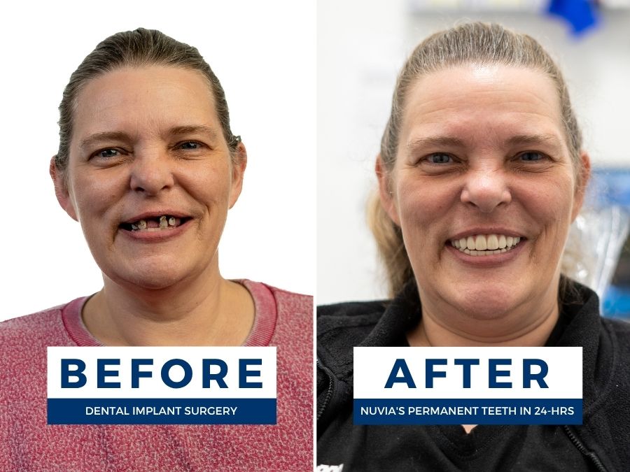 Woman smiling before and after getting new teeth