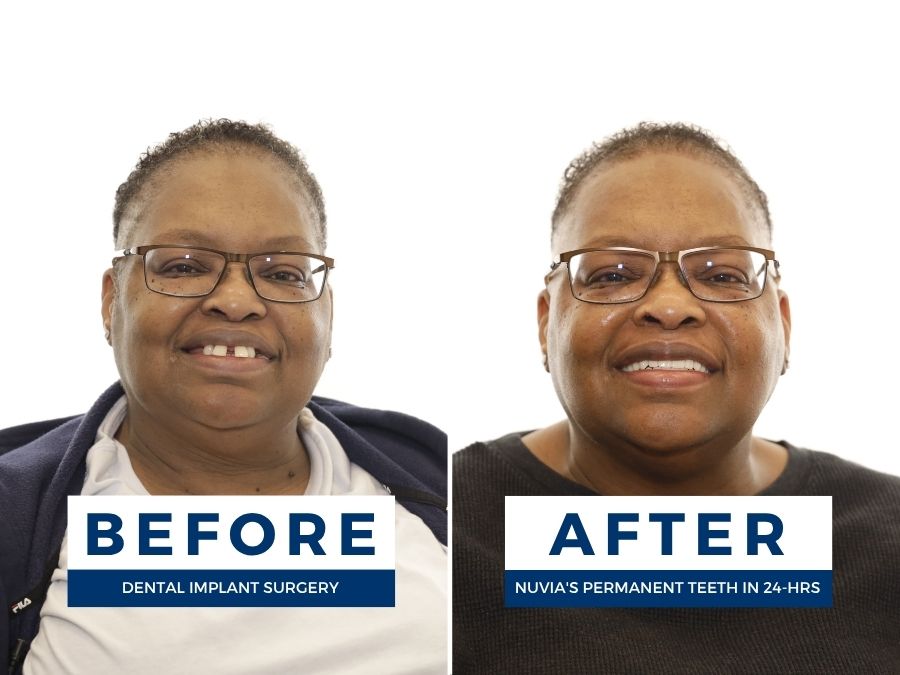 Woman smiling before and after getting new teeth