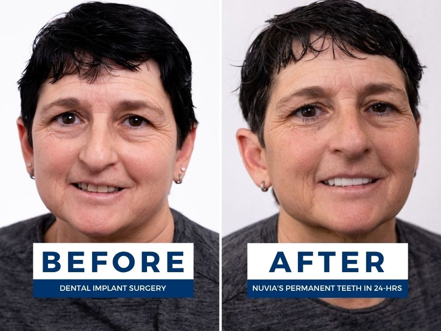 Woman  smiling before and after getting new teeth