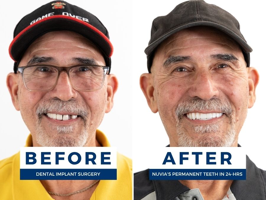 Man smiling before and after getting new teeth
