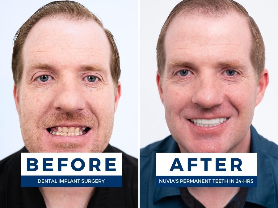 Man smiling before and after getting new teeth