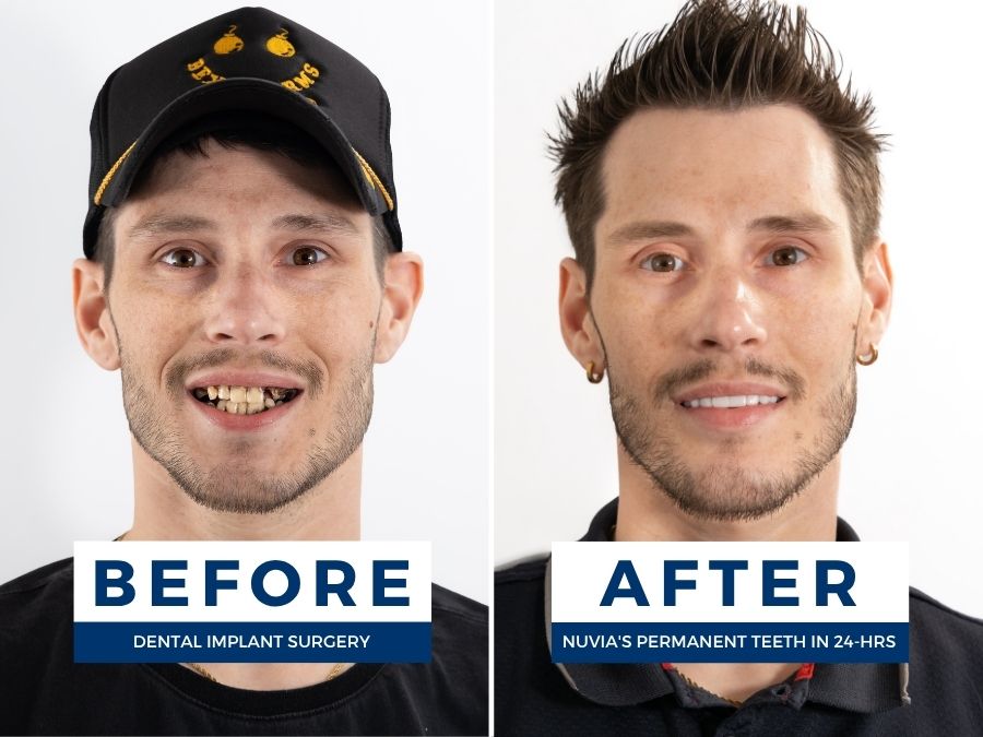 Man smiling before and after getting new teeth