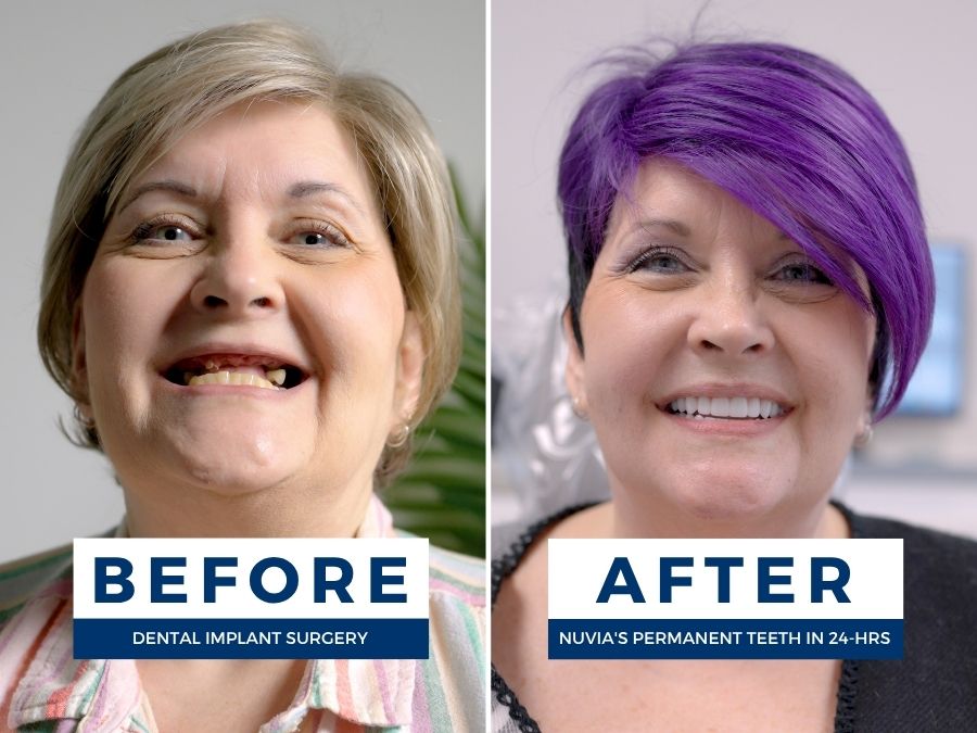 Woman smiling before and after getting new teeth