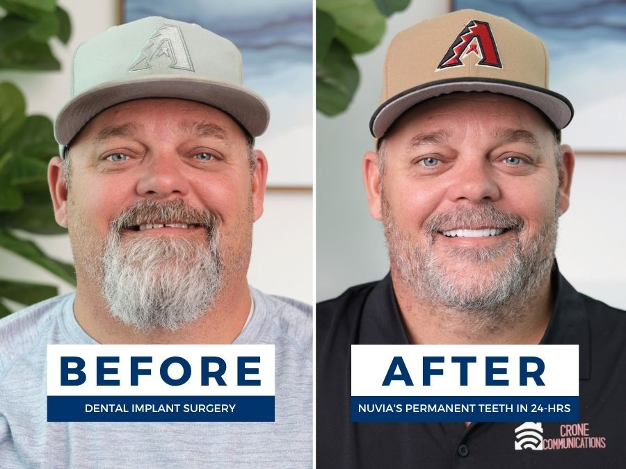 Man smiling before and after getting new teeth