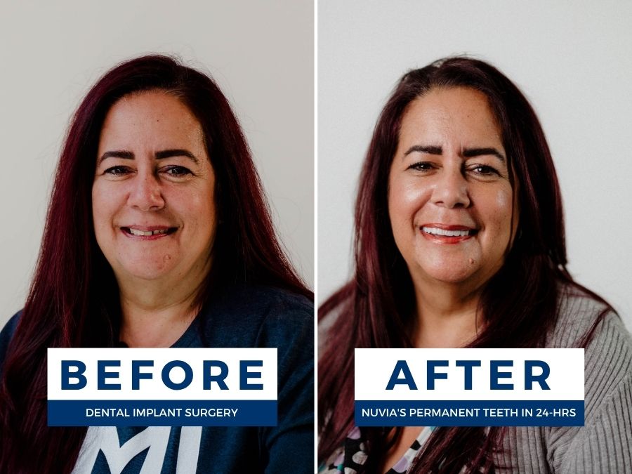 Woman smiling before and after getting new teeth