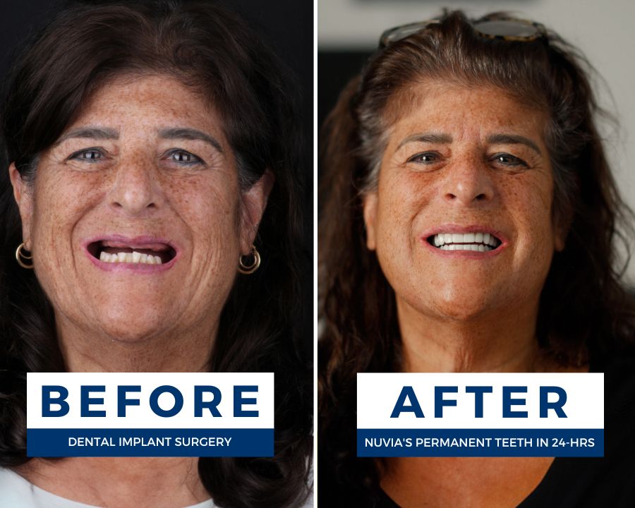 Two photos of a woman; one smiling before dental implants and one smiling after