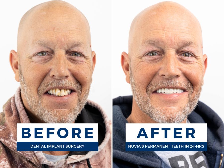 Two photos of a man; one smiling before dental implants and one smiling after