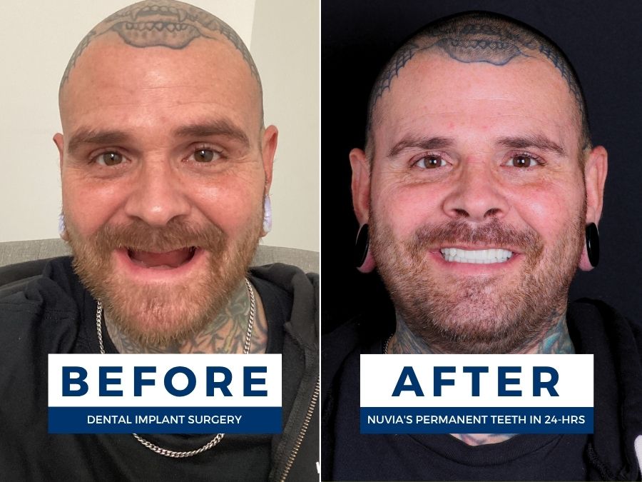 Man smiling before and after having snap in dentures replaced by dental implants