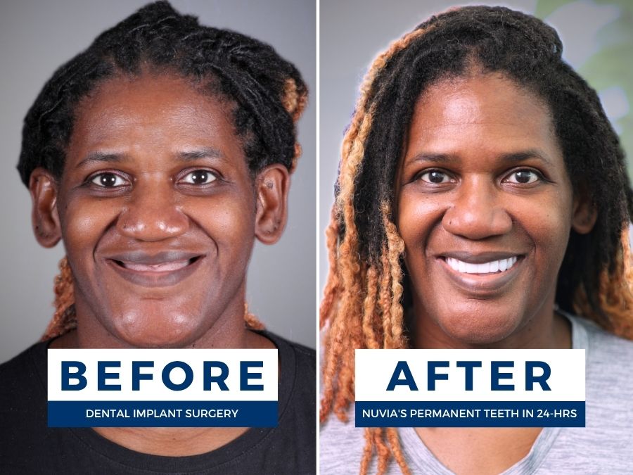 Woman smiling before and after having snap in dentures replaced by dental implants
