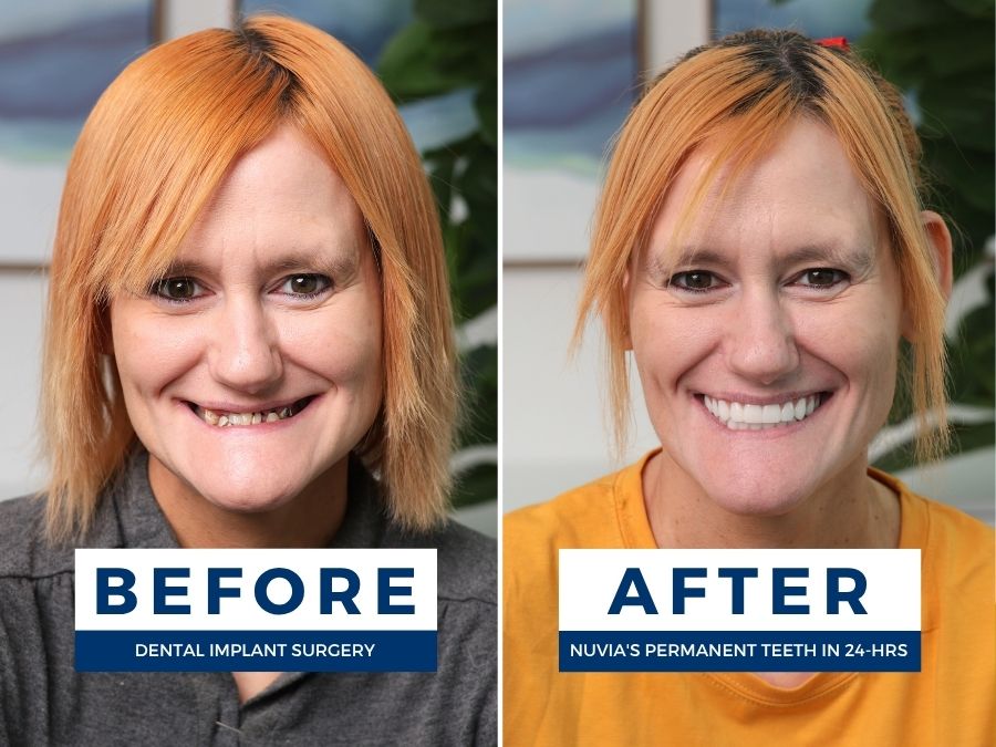 Woman smiling before and after having snap in dentures replaced by dental implants